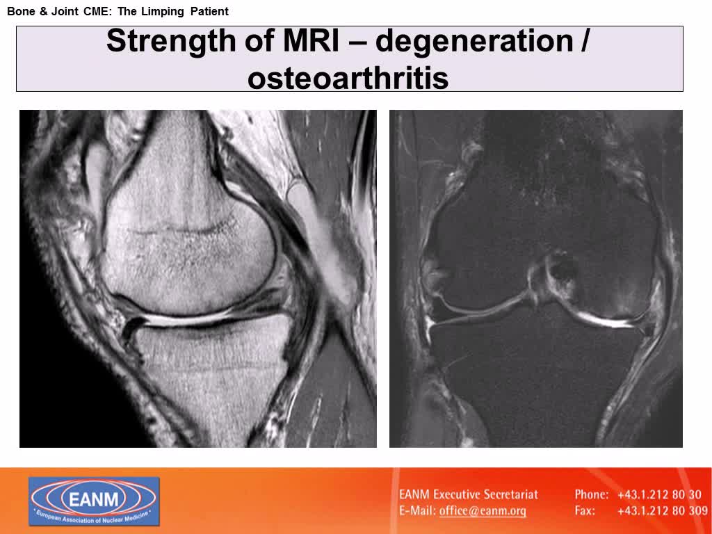 SPECT CT in Knee Joints-What is Left for Nuclear Medicine Tests at the Era of MRI