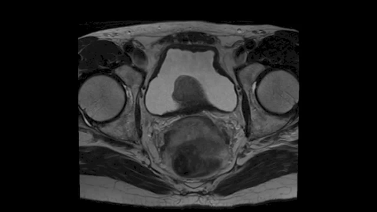 Successful 'salvage' holmium laser enucleation of prostat..-