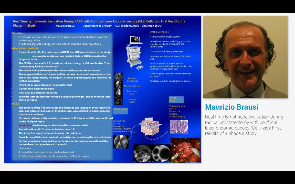 Real time lymphnode evaluation during radical prostatecto..-