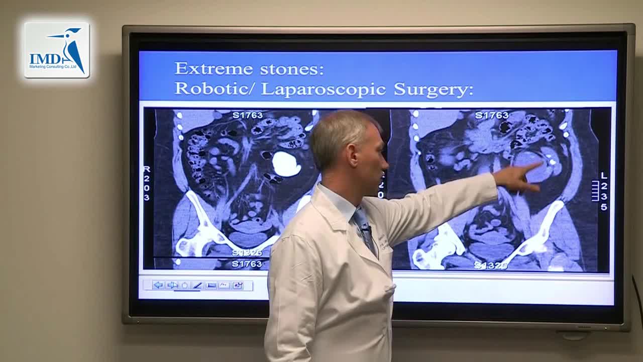 治疗肾结石的最新进步和发展（6）