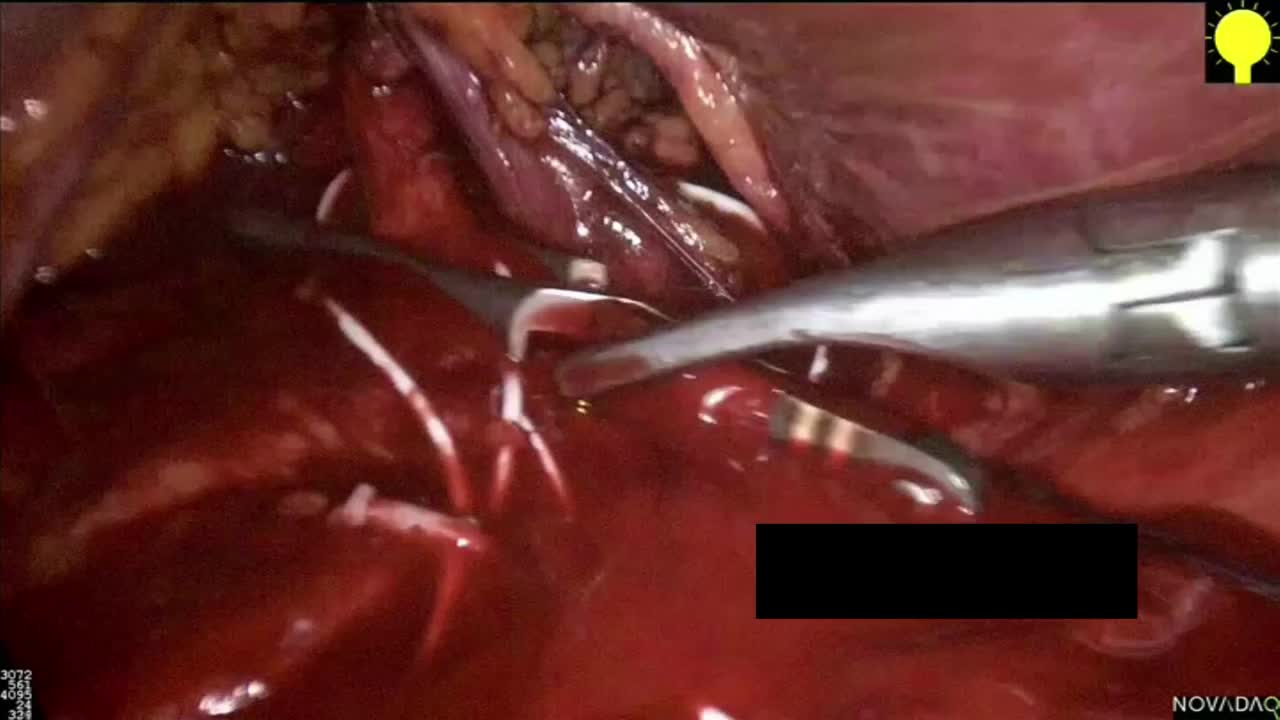 Renal pedicle injuries during minimally invasive parti..-