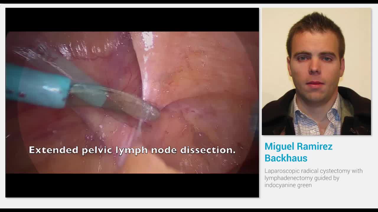 Laparoscopic radical cystectomy with lymphadenectomy guid..-