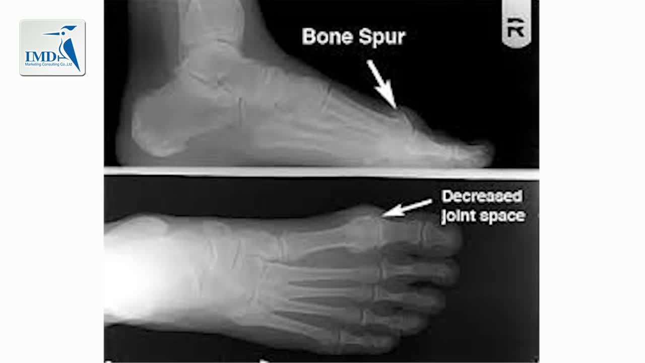 大脚趾关节炎的治疗