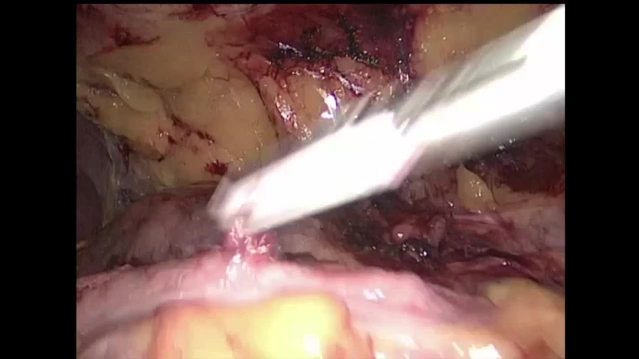 Laparoscopic management of renal tumour in a horseshoe ki..-