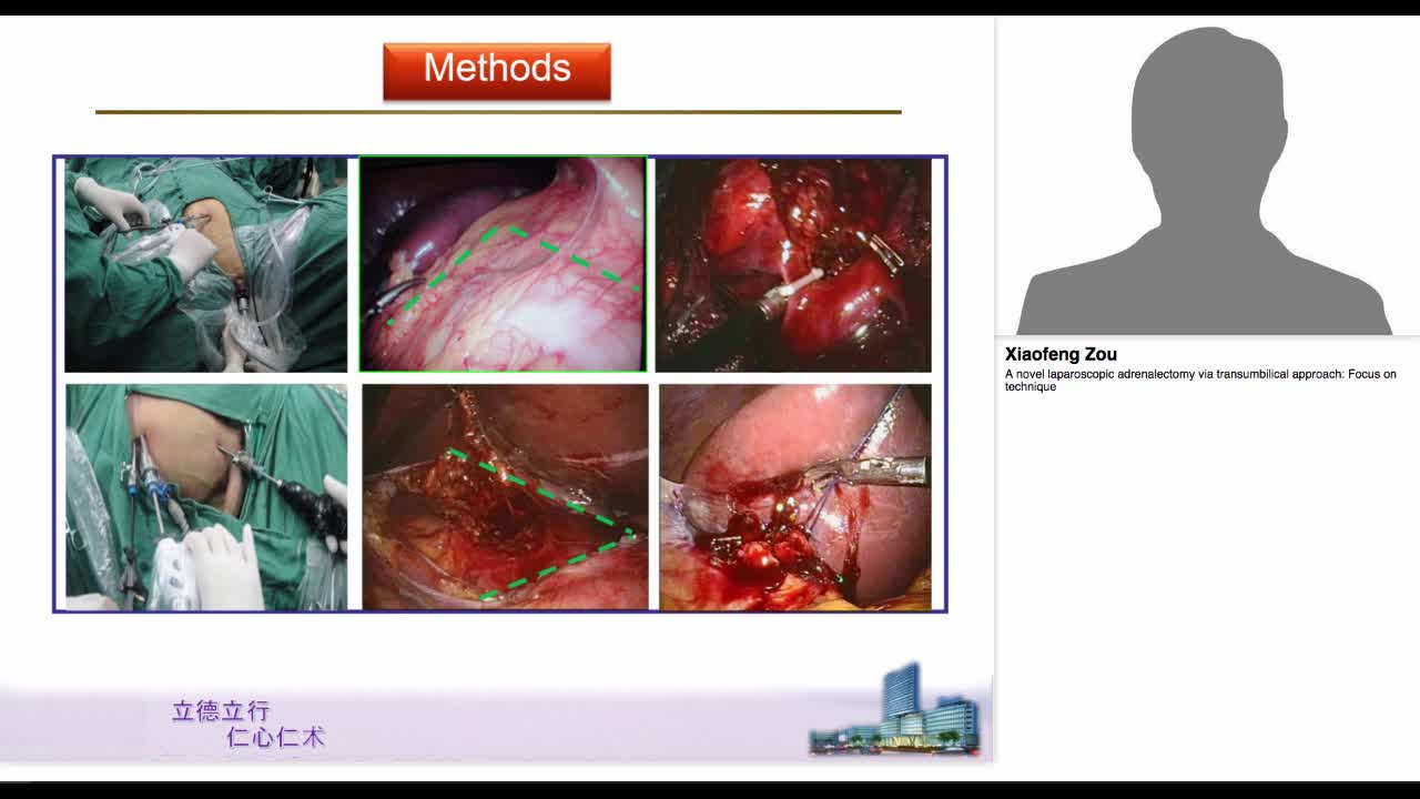 A novel laparoscopic adrenalectomy via transumbilical app-