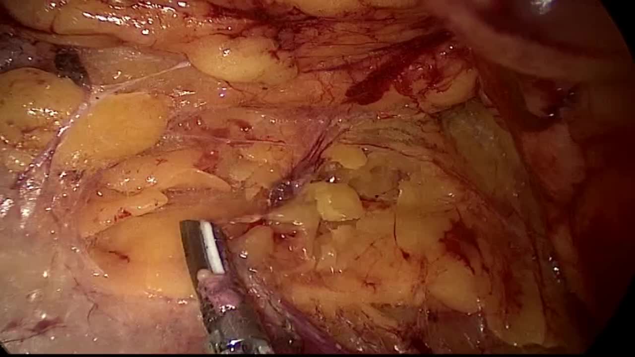 Ipsilateral multiple renal tumor, Laparoscopic conservati..-