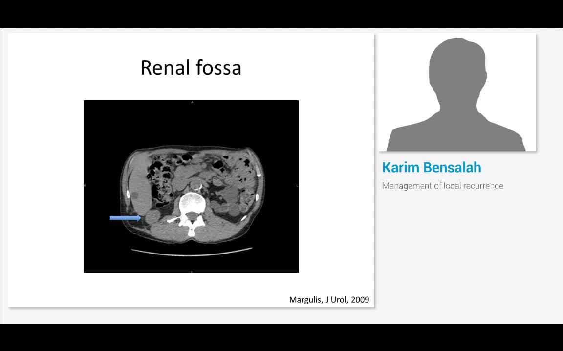局部复发的管理