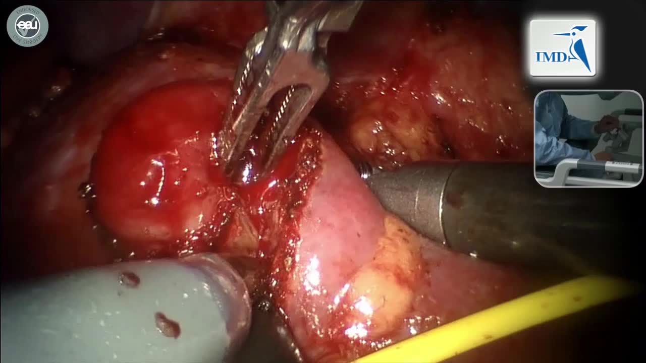 肾脏肿瘤切除手术（3）