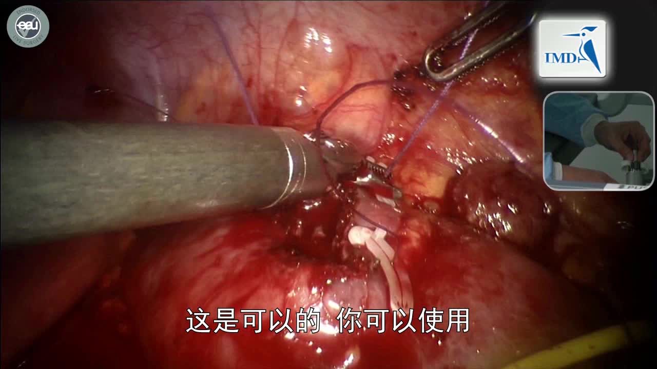 肾脏肿瘤切除手术（4）