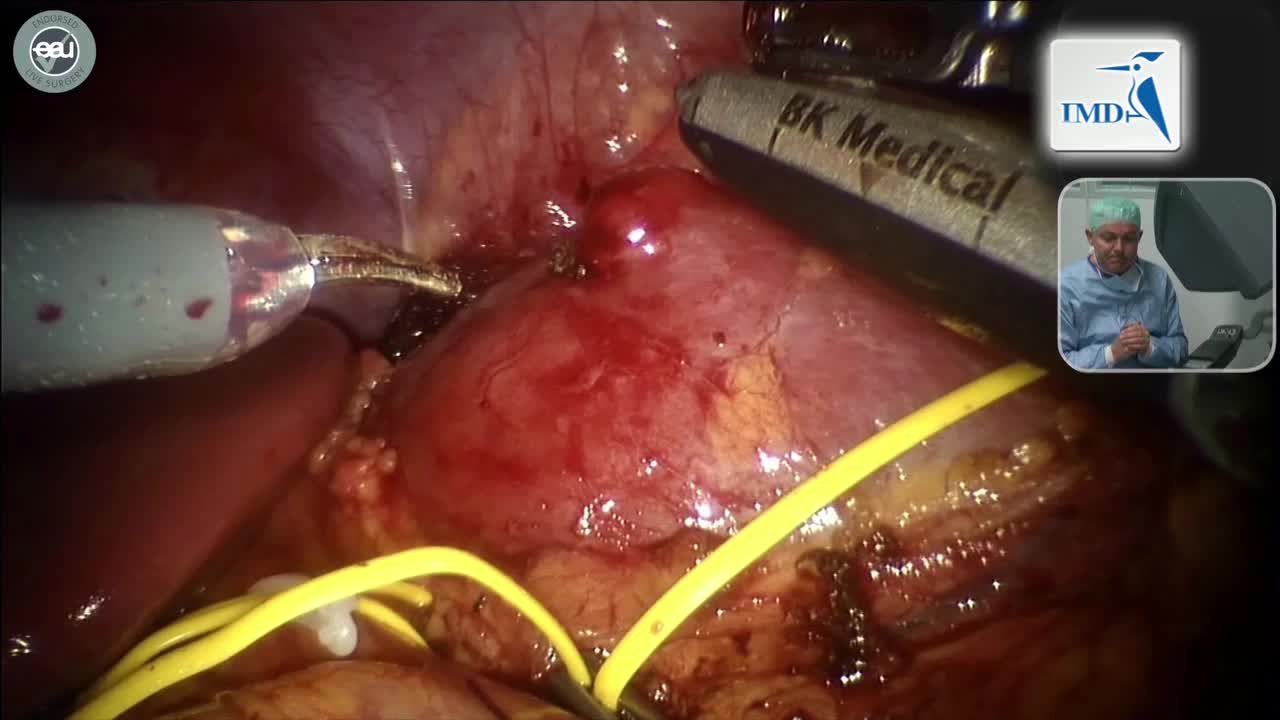 肾脏肿瘤切除手术（2）