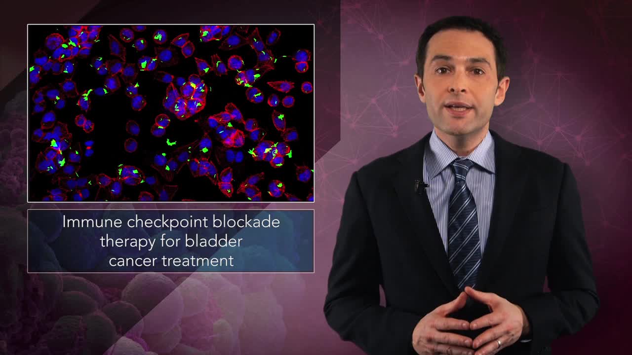 有广阔前景的膀胱癌新免疫疗法