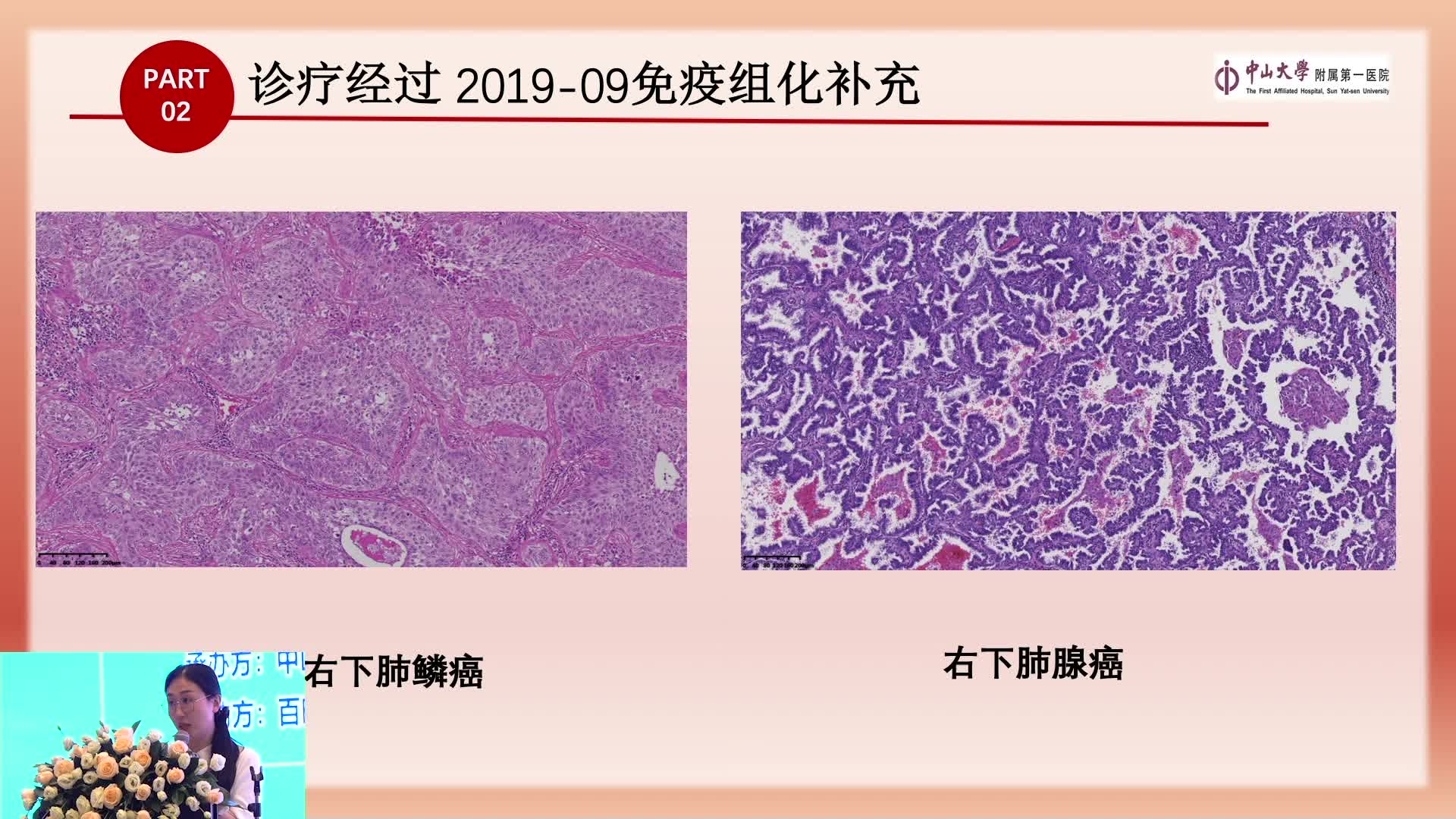多原发肺癌术后辅助治疗方法的选择原则