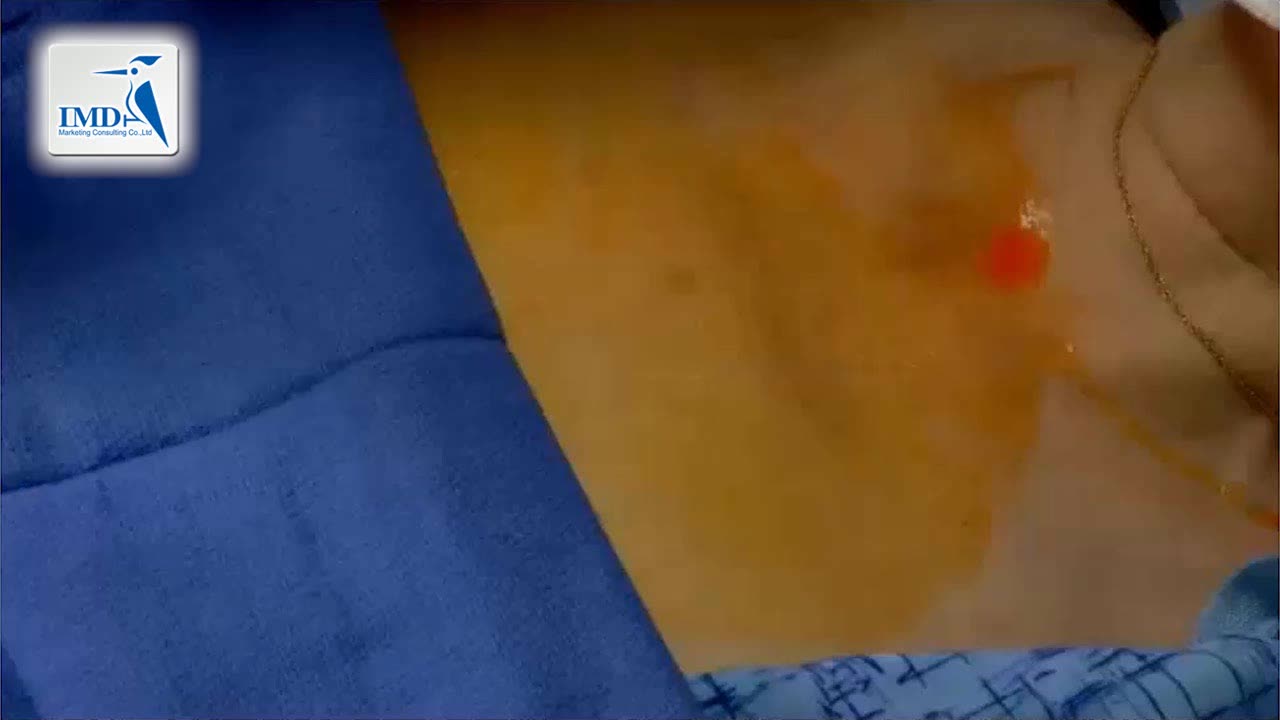 06如何植入心脏监测器