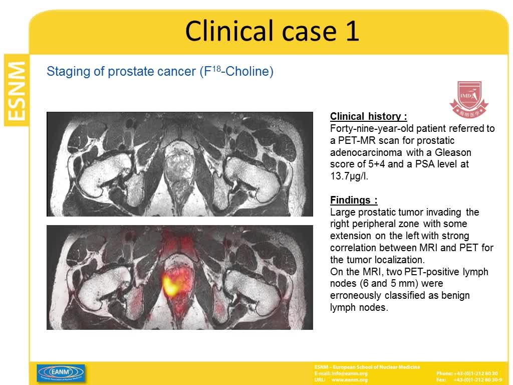 前列腺癌中的 PET MRI影像3