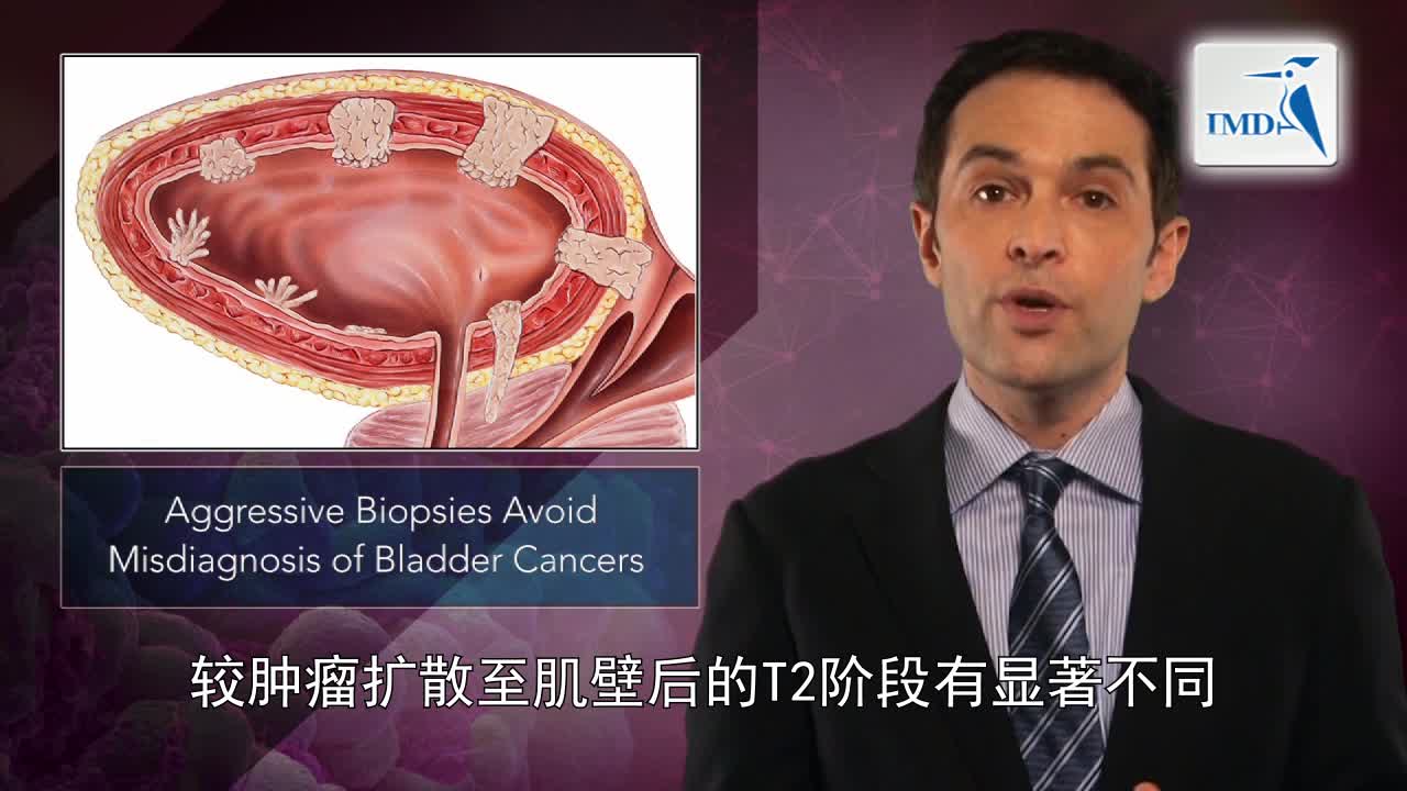 01膀胱癌精准分期对治疗的作用