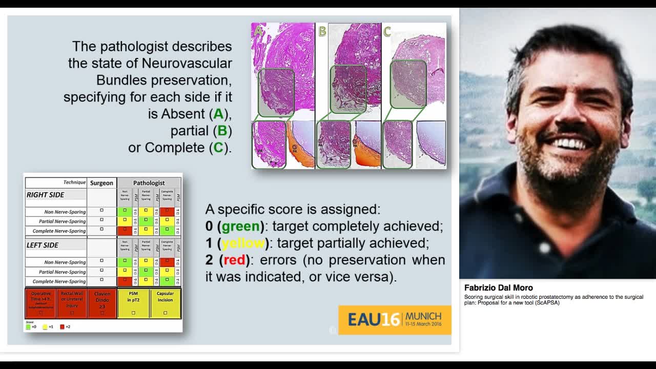 Scoring surgical skill in robotic prostatectomy as adhere-