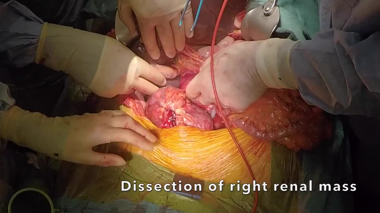 Contemporary open surgical techniques for intracardiac re..-