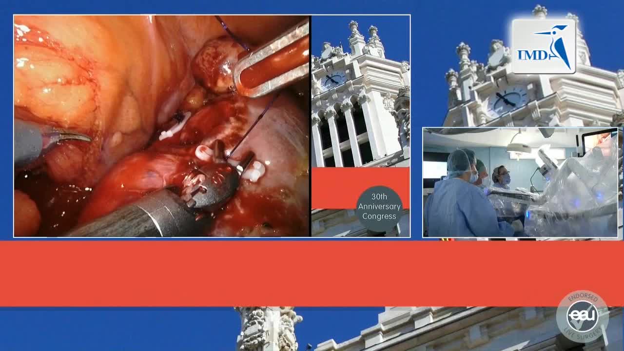 机器人辅助吲哚氰绿染色肾部分切除术（4）