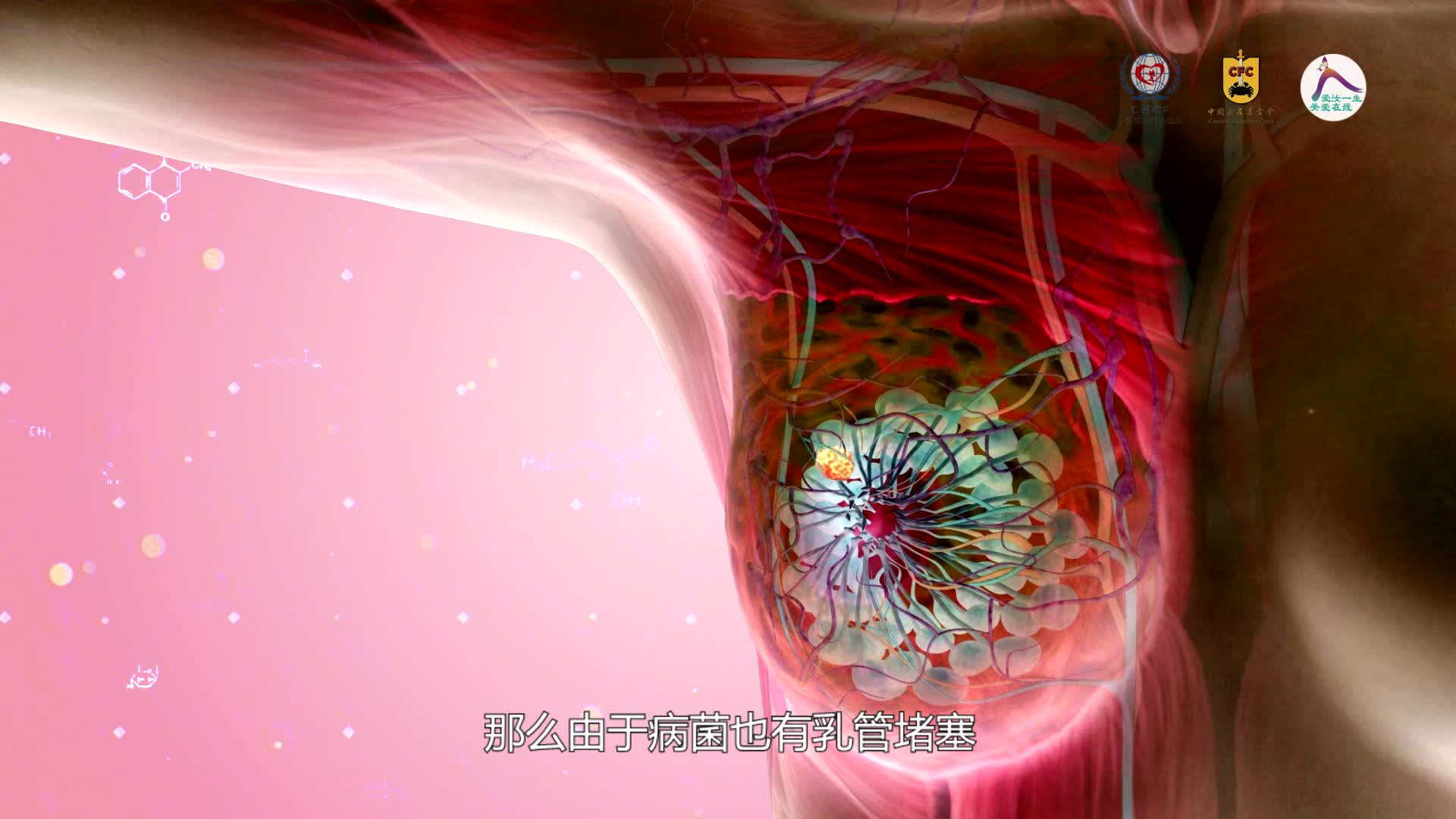 常见良性乳腺疾病的诊治--张瑞