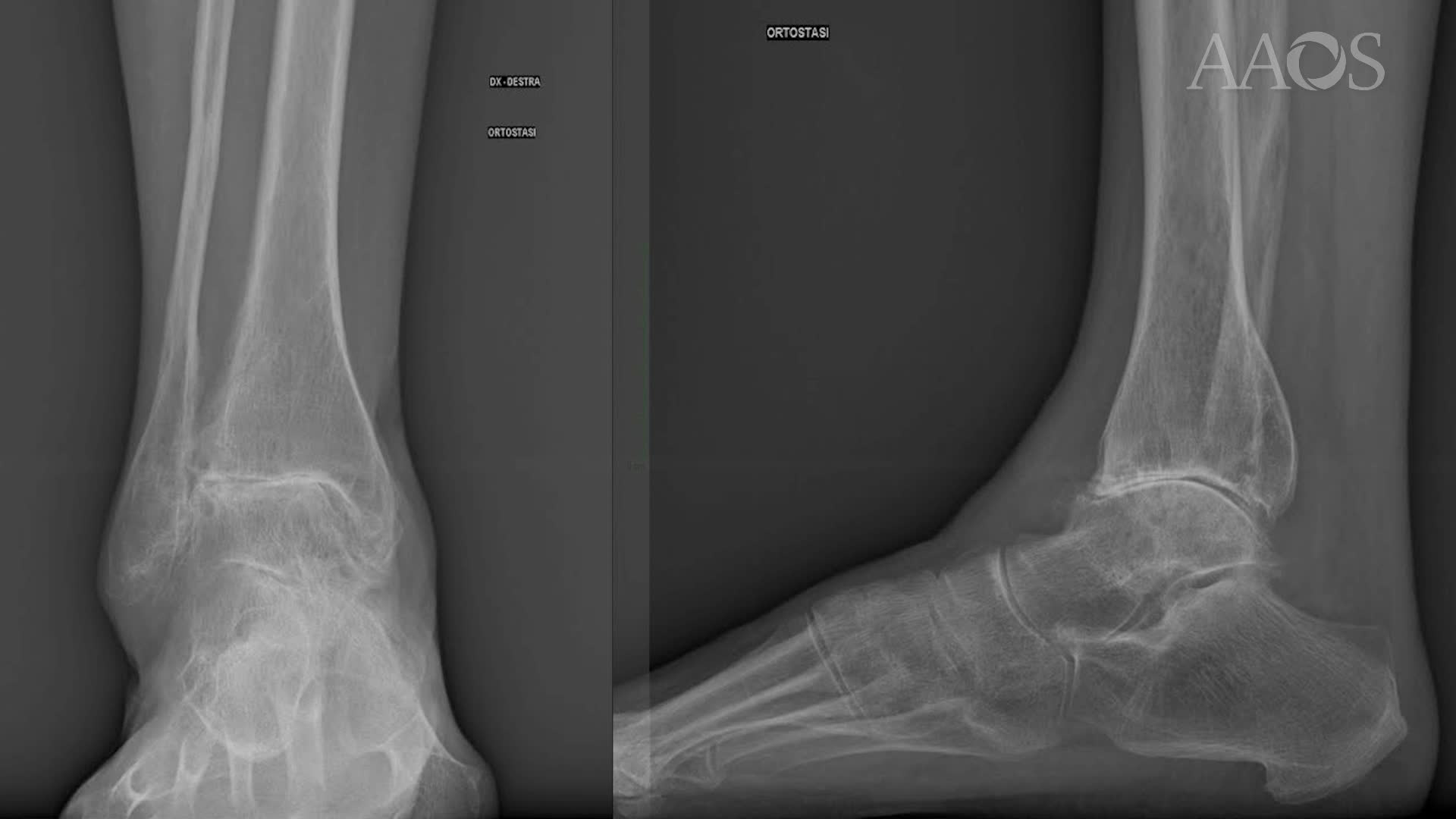 UNIVERSITY OF BOLOGNA ISTITUTO ORTOPEDICO RIZZOLI