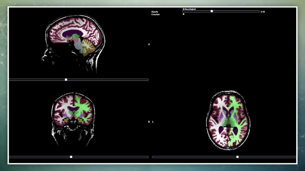 先进的神经诊断软件有助于医生制定更好的治疗计划