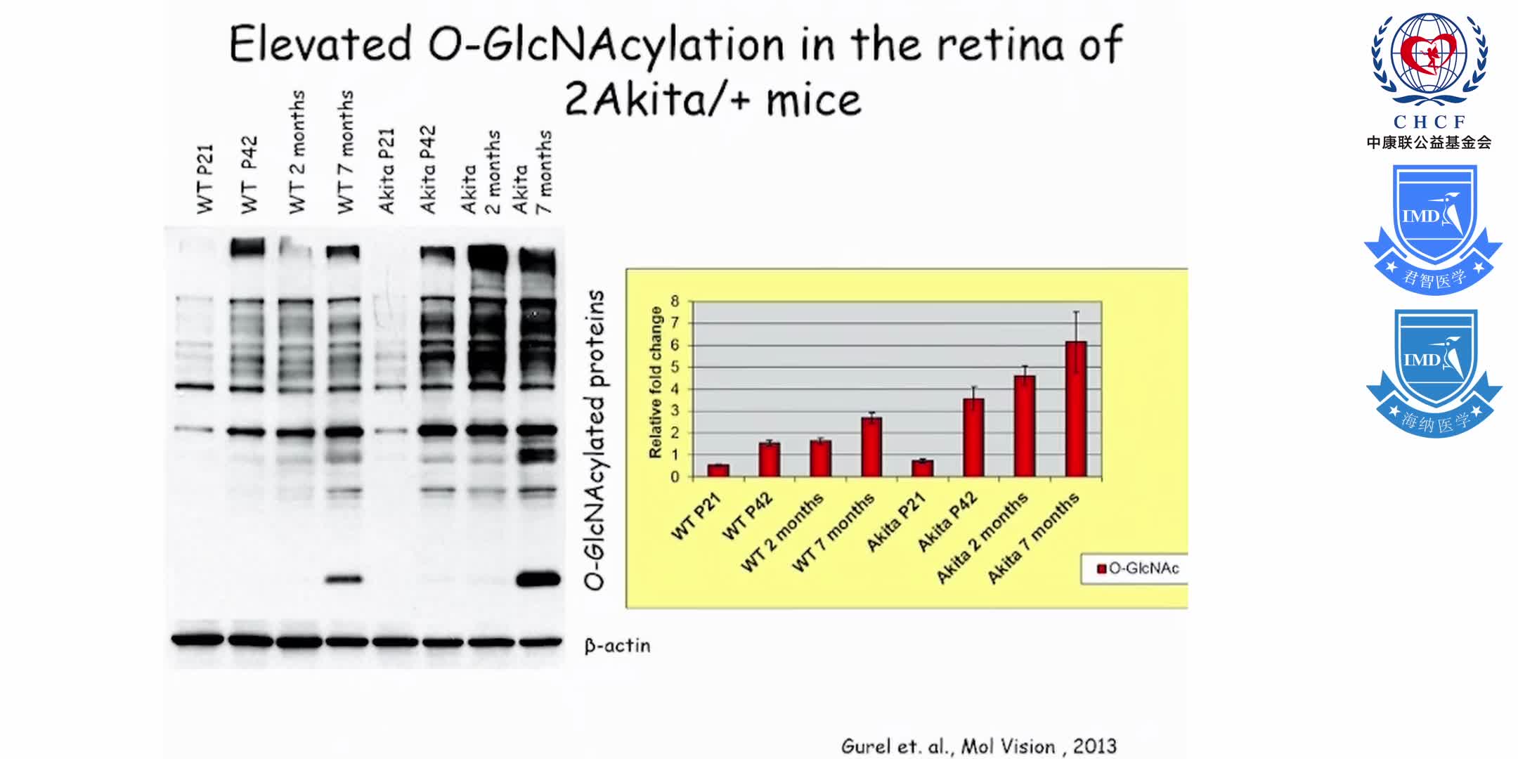 增生型糖尿病视网膜病变 1-11