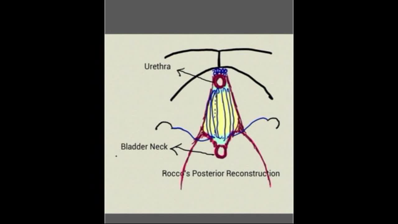 A novel technique of dynamic lateral suspension of poster..-