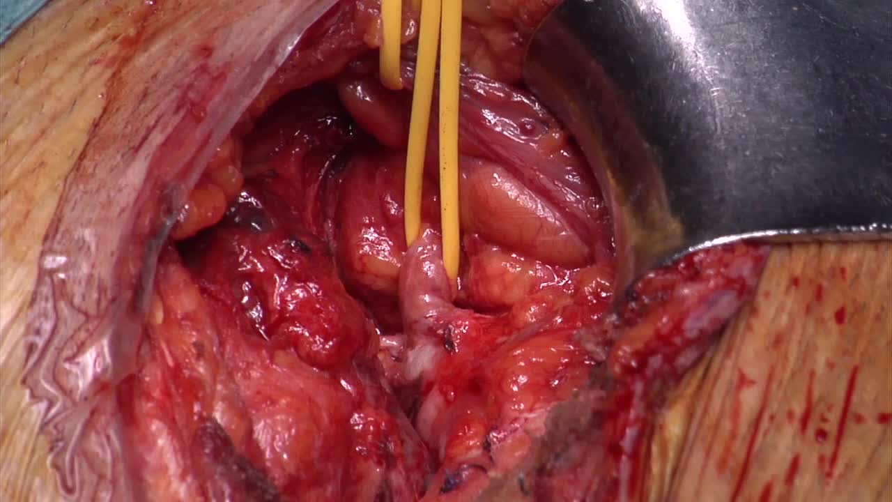 Endoscopic resolution of surgical challenges after kidney..-