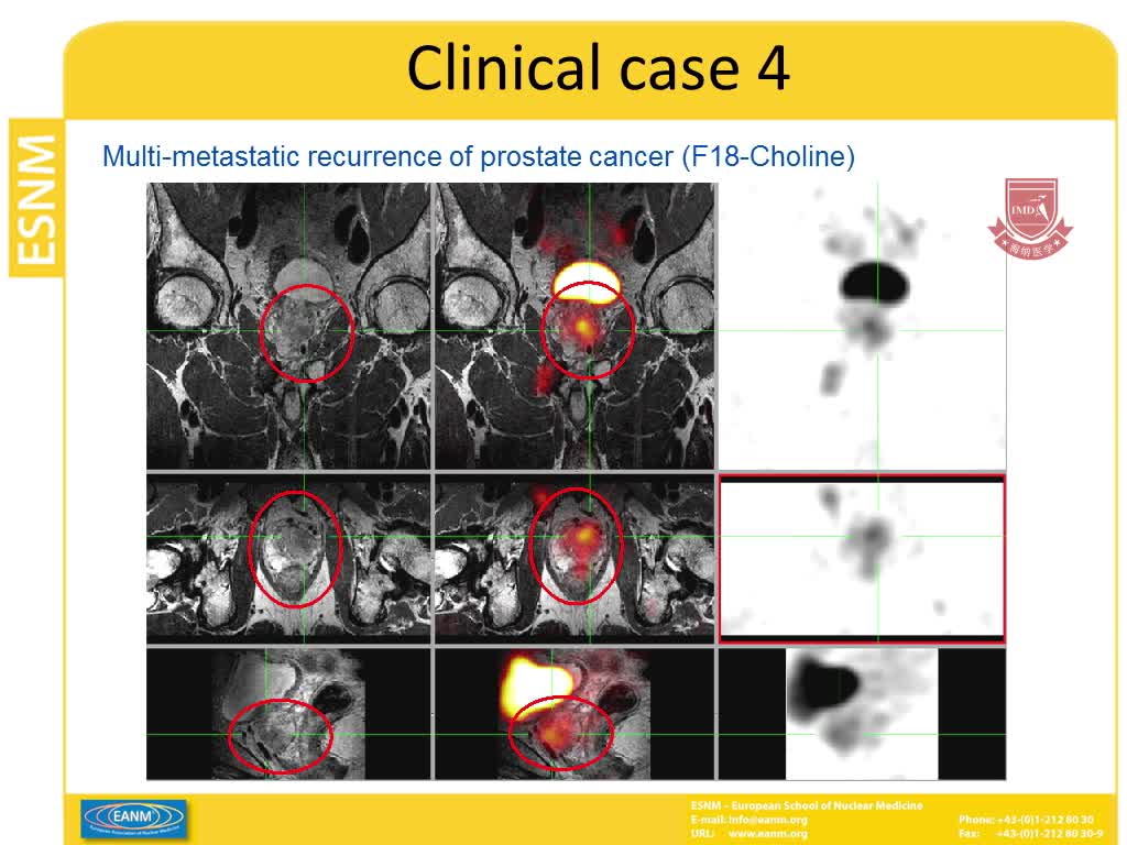 前列腺癌中的 PET MRI影像4