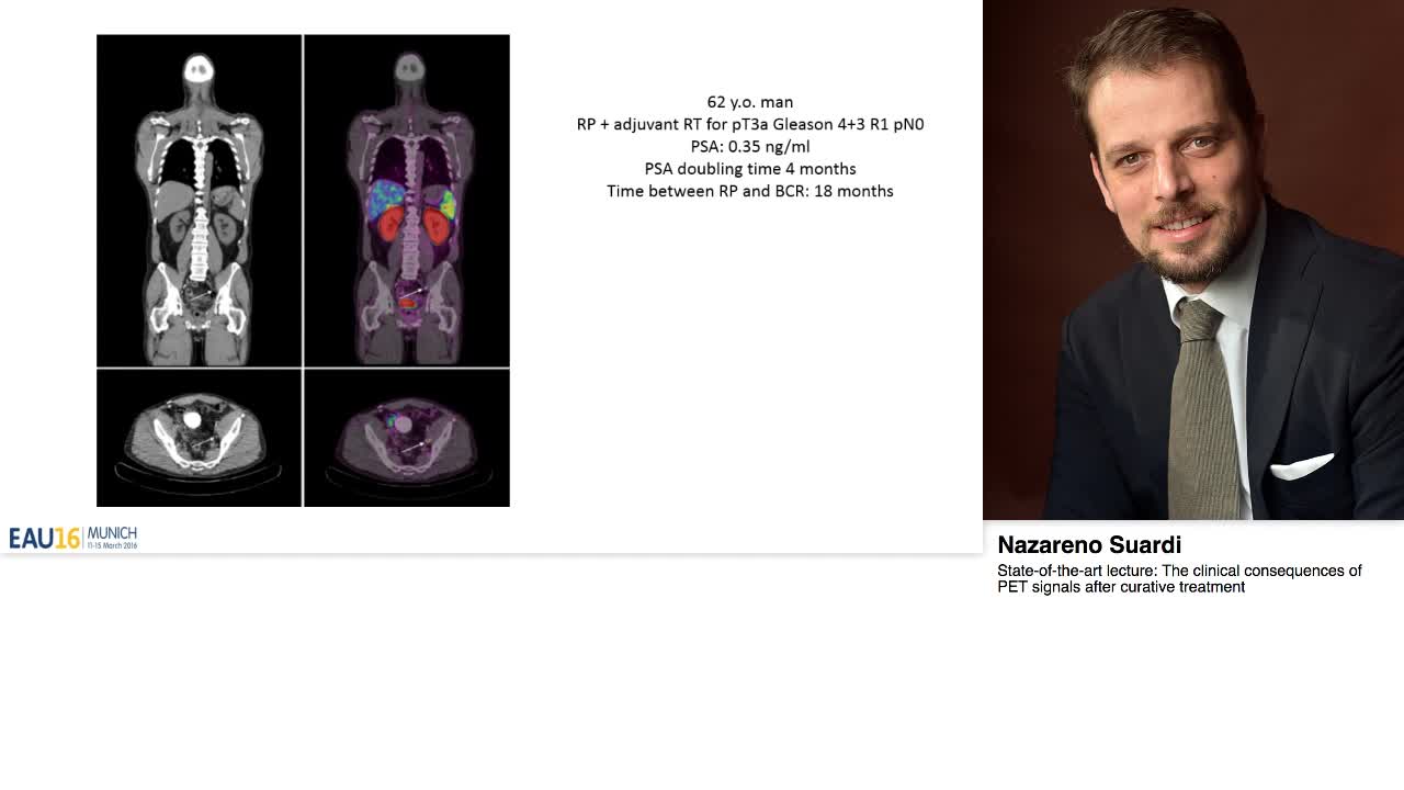 The clinical consequences of PET signals after curative t-
