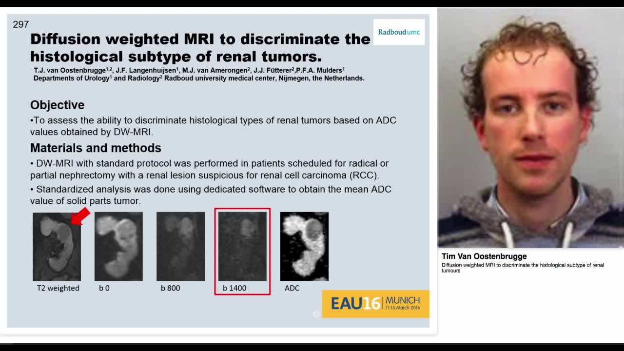 Diffusion weighted MRI to discriminate the histological s-