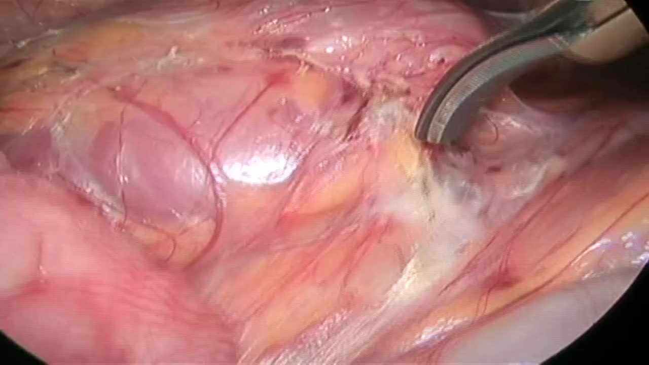 Laparoscopic right partial nephrectomy for pediatric meta..-
