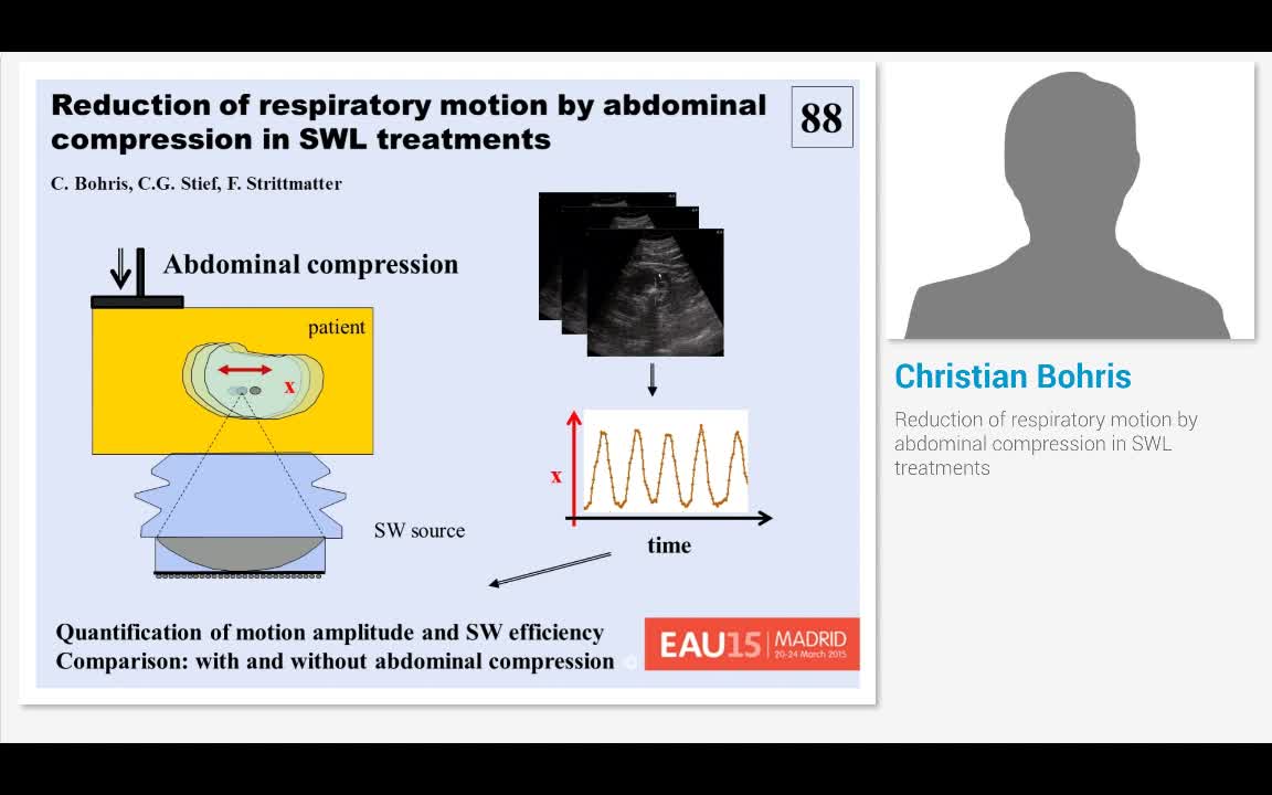 Reduction of respiratory motion by abdominal compression ..-