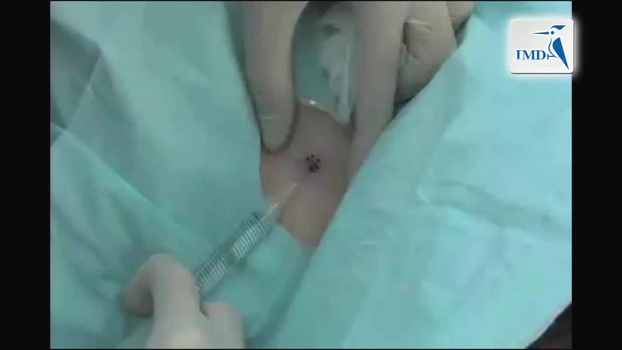 如何进行穿刺活检