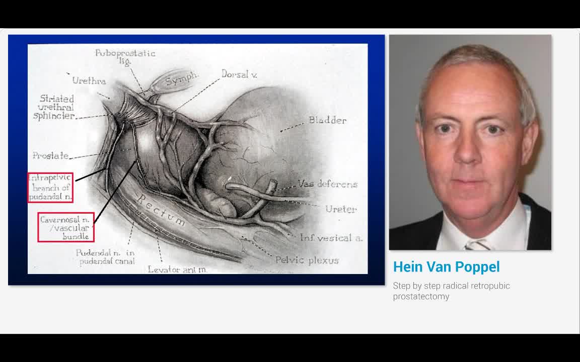 Step by step radical retropubic prostatectomy