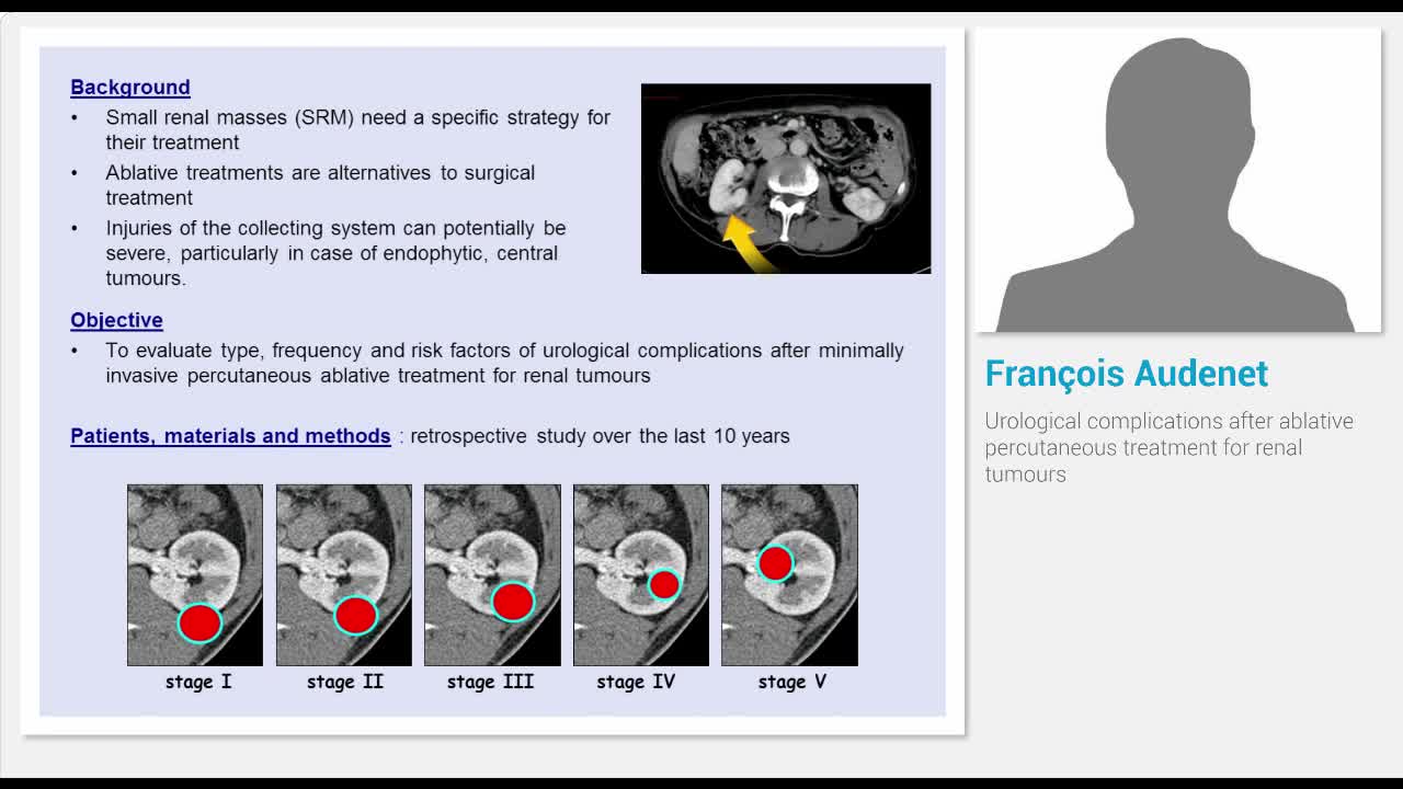 Urological complications after ablative percutaneous trea..-