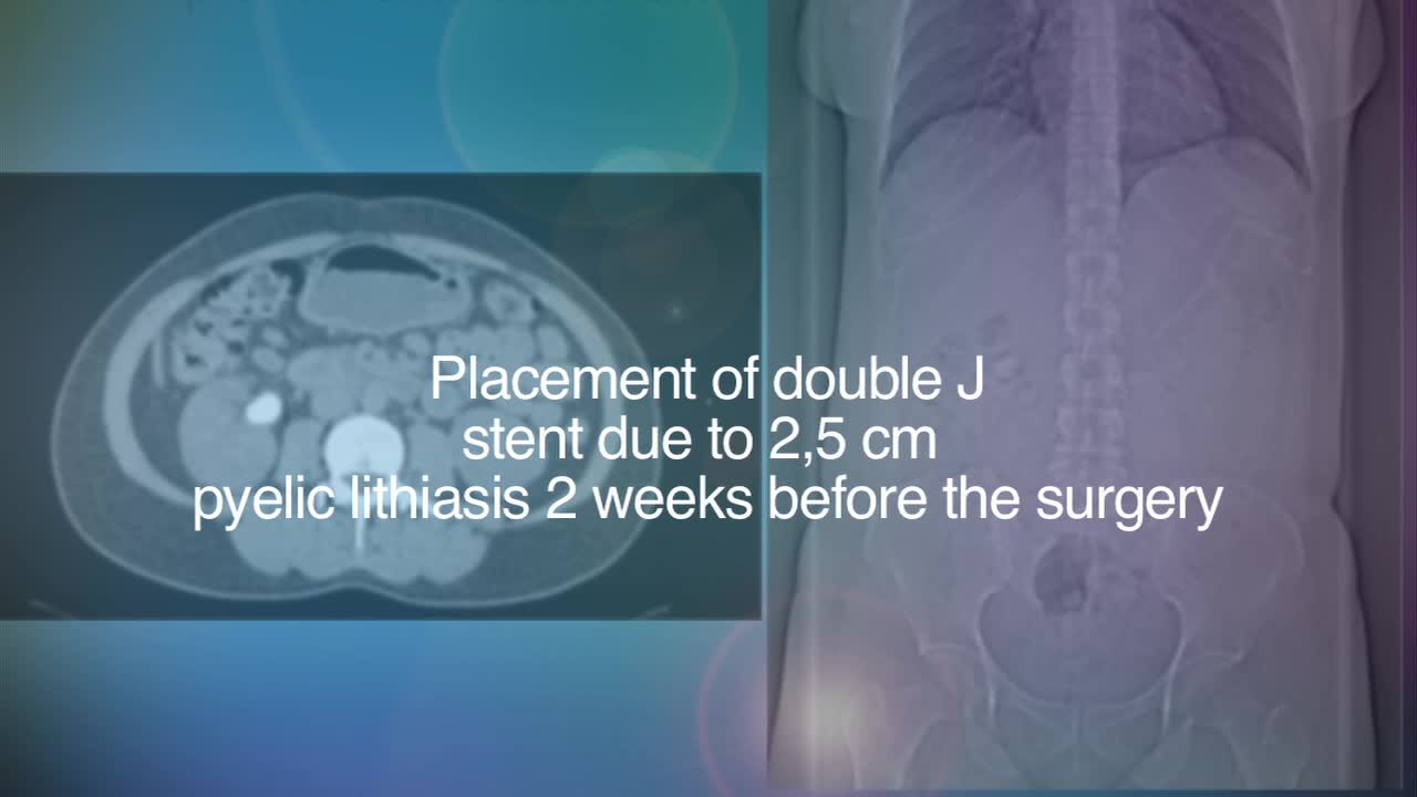 Therapeutic approach to moderate-sized pyelic lithiasis