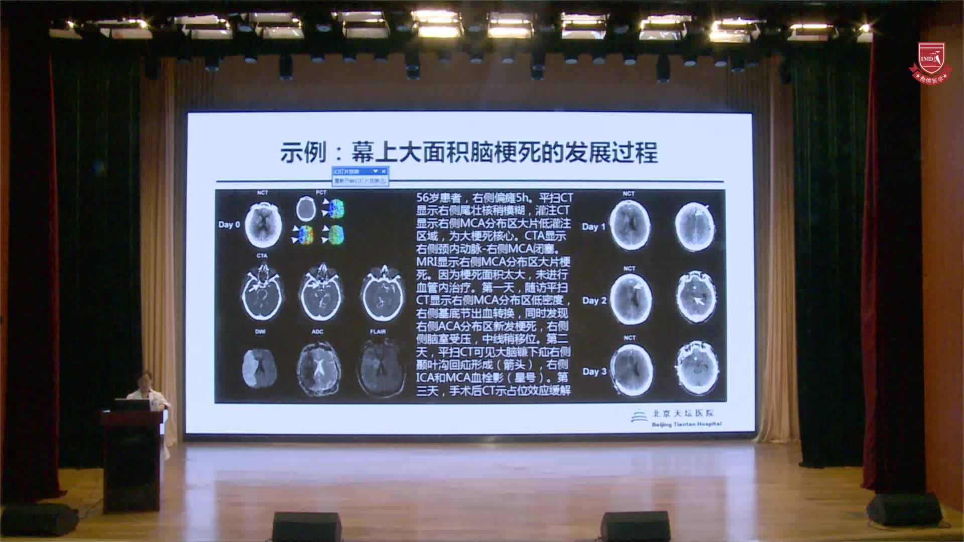 大查房-渗透性治疗，习惯能否改变？浅谈幕上大面积脑梗死的抗水肿管理5