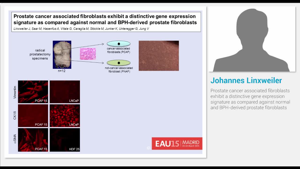 Prostate cancer associated fibroblasts exhibit a distinct..-