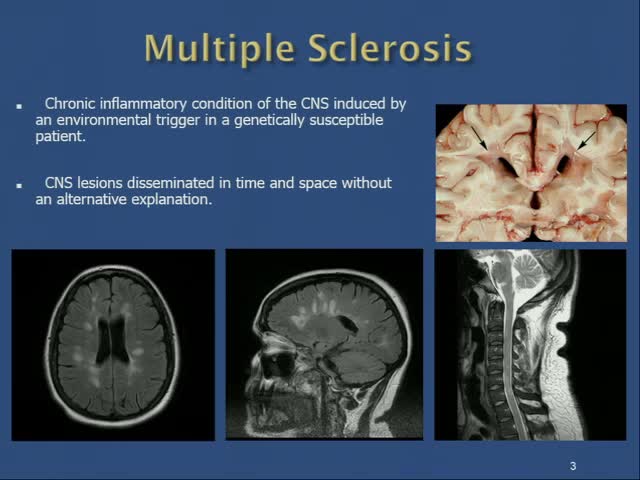Overview and Diagnosis of Multiple Sclerosis