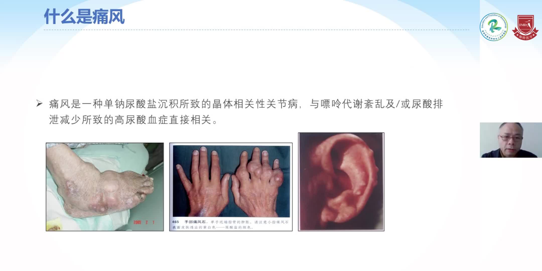 周京国-痛风性关节炎