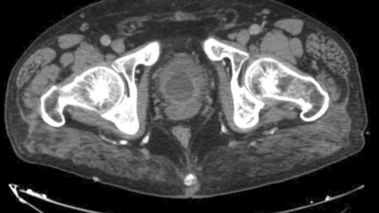 Robotic supratrigonal cystectomy with ileocystoplasty