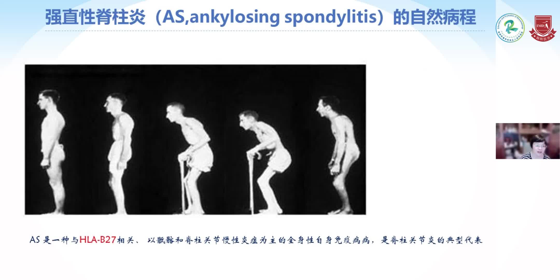 朱静-脊柱关节炎的规范化诊治