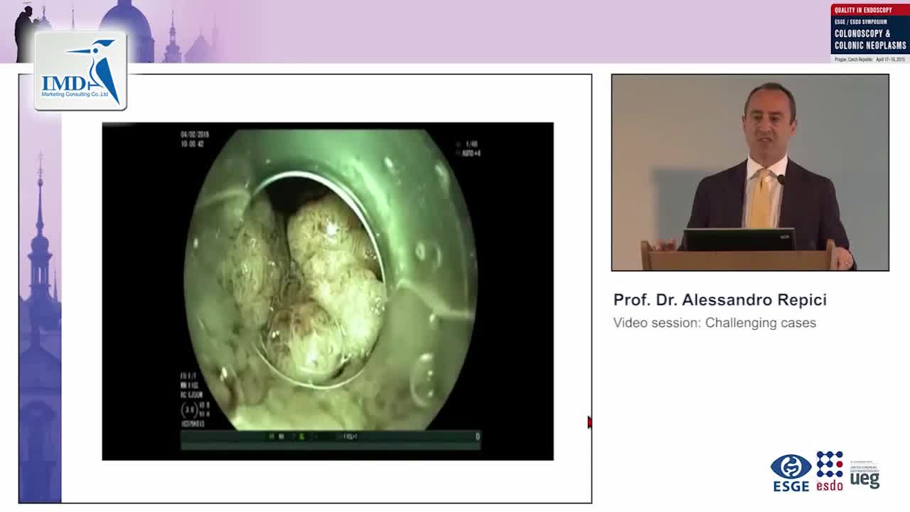 息肉切除术的挑战（2）