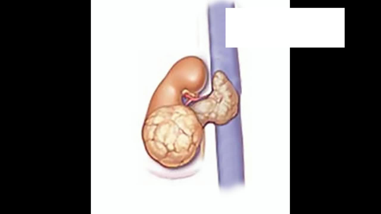 Robot assisted radical nephrectomy and inferior vena cava..-