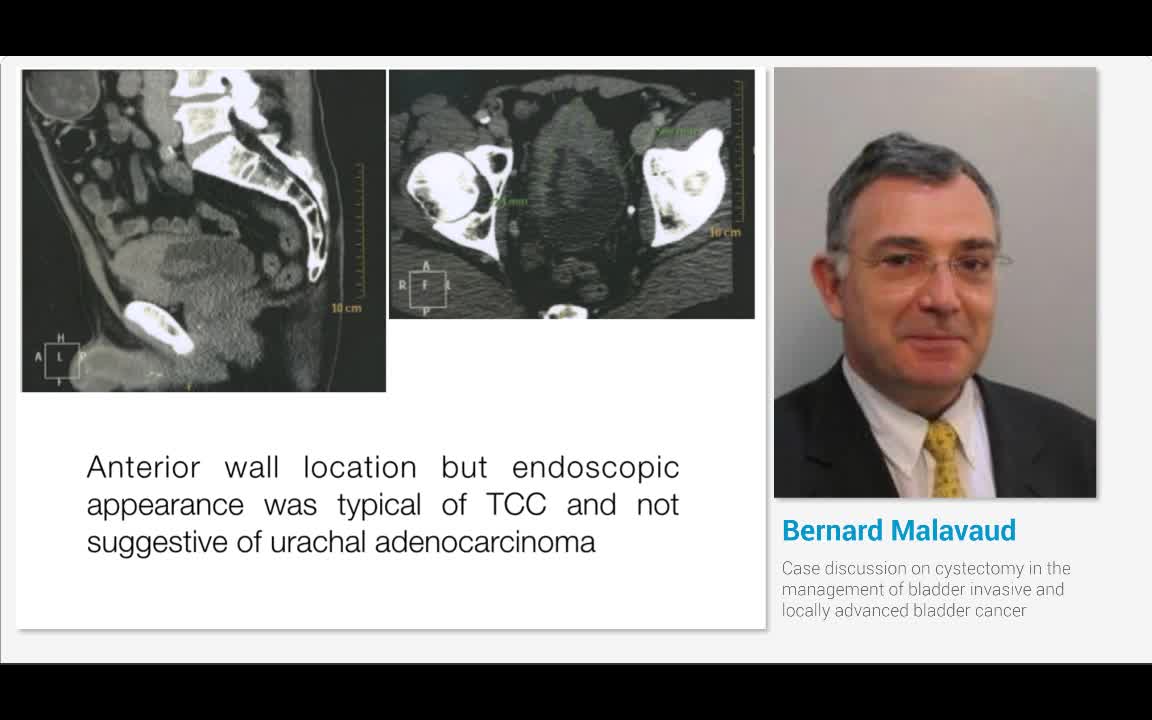 Case discussion on cystectomy in the management of bladde..-