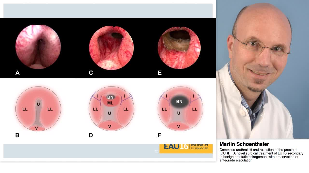 Combined urethral lift and resection of the prostate (CUR-