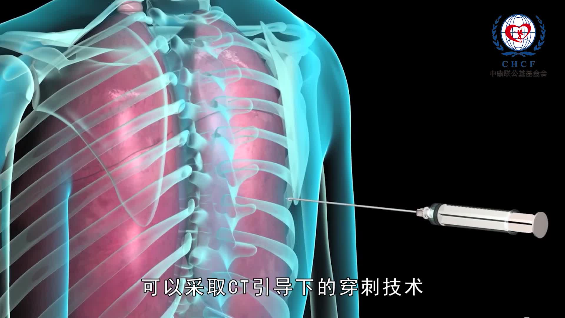 肺癌患者放射治疗前需要做哪些检查-季永领