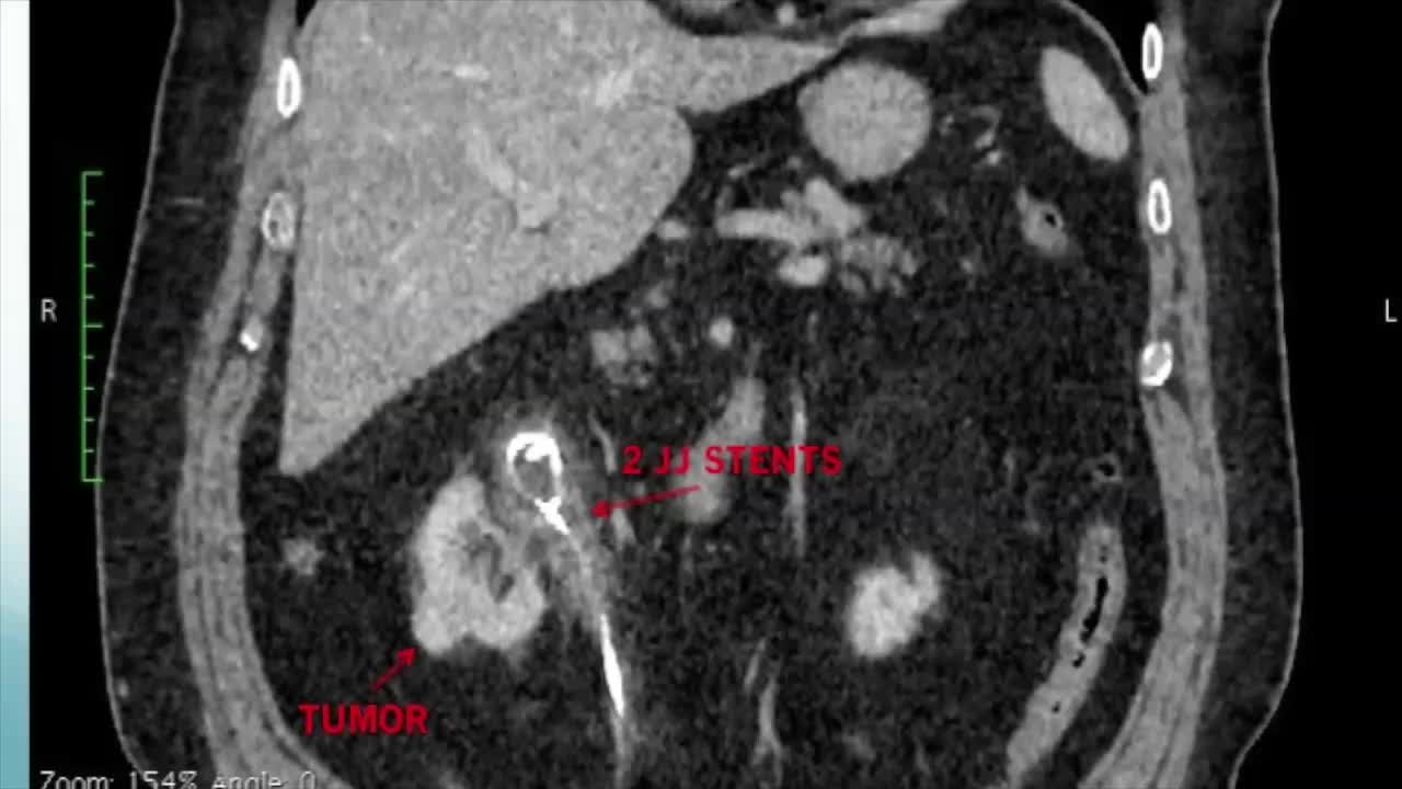 Laparoscopic management of a left in situ calcified doubl..-
