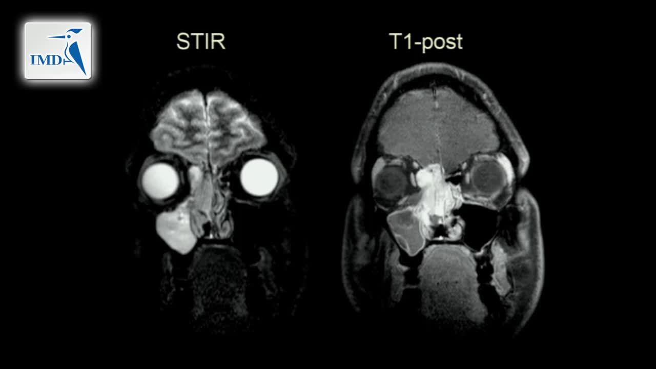 《神经科》2019年第2讲（总第157讲）基于病例学习神经影像学（2）